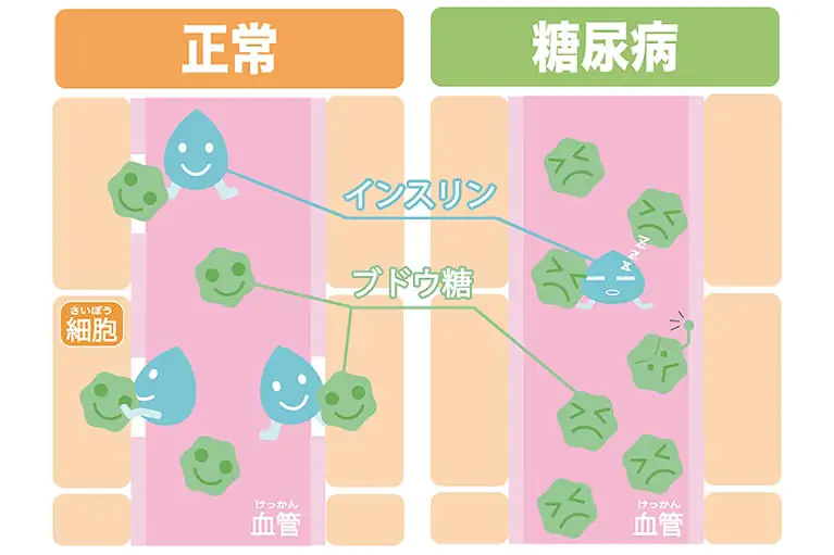脸上7征兆「恐是糖尿病」