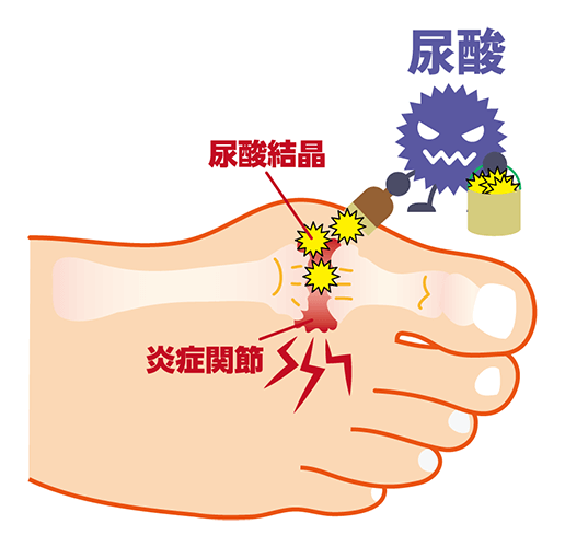 成年人尿酸高（即高尿酸血症）原因